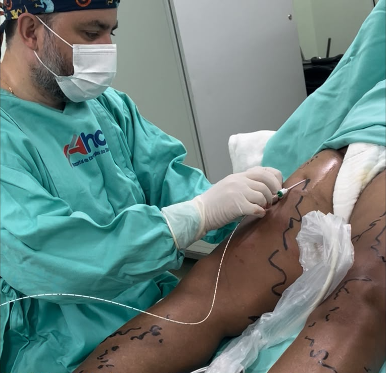 Tratamento vascular a laser