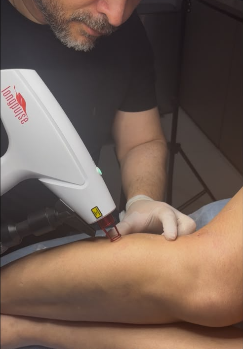 Tratamento vascular a laser
